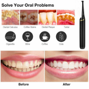 Electric Dental Calculus Remover Tooth Cleaner